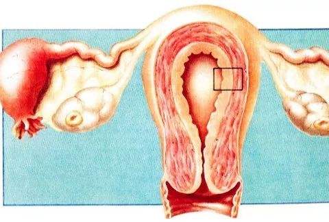 子宫内膜增生症有必要进行刮宫吗？